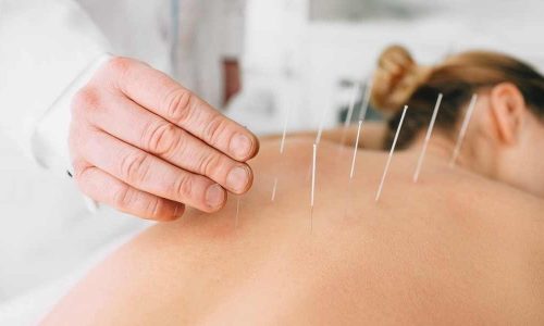 Acupuntura en fisioterapia en Elche